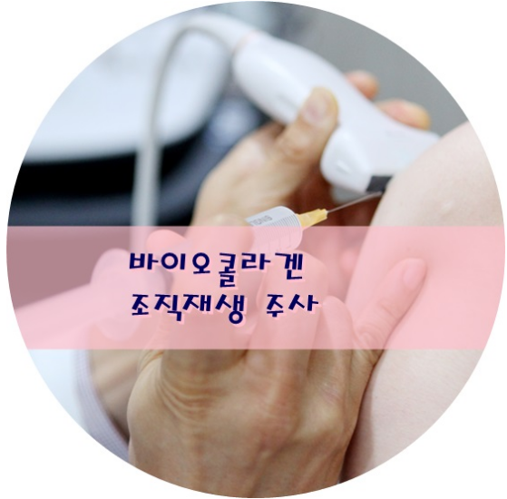 초음파 유도 인대조직재생치료