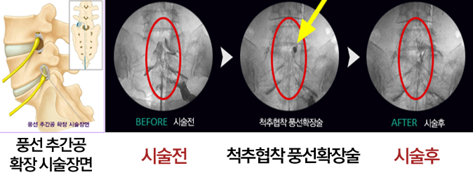  척추협착 풍선확장술