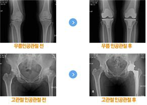 인공관절 치환술